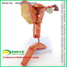 VENDER 12473 Modelo patológico uterino femenino de ciencia médica humana